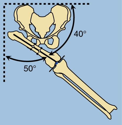 Pelvic Support Osteotomy - Paley Orthopedic & Spine Institute