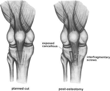 TTO Osteotomy