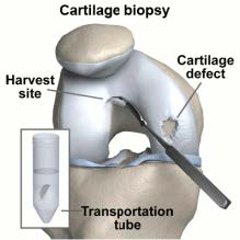Cartilage Biopsy