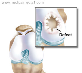 Cartilage Defect