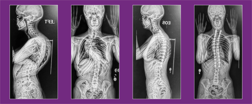 Pediatric Scoliosis X-rays before and after