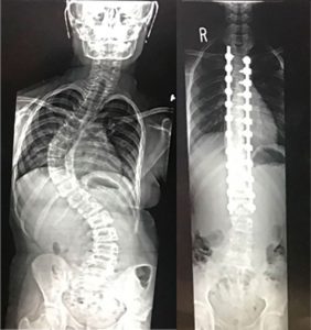 An example of a before & after spinal fusion with Dr. Feldman