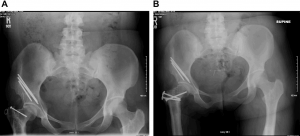 preservation coxa vara paley overgrown femur performed osteotomy trochanter congenital